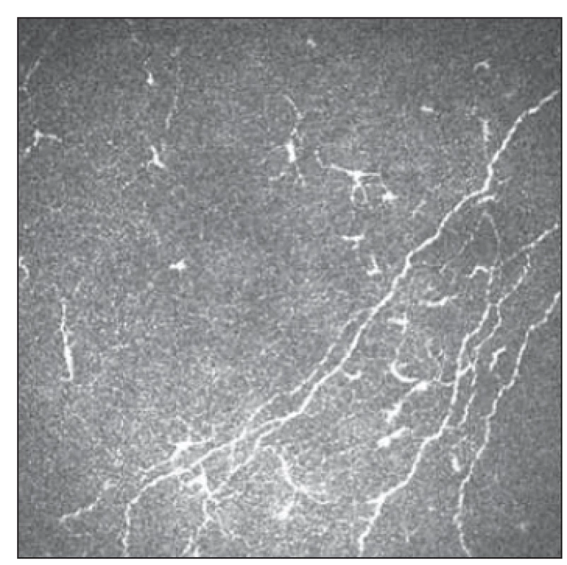 Patologické postižení tenkých vláken
s patrnou aktivitou Langerhansových
buněk 2.<br>
Fig. 6. Small fiber pathology with Langerhans
cell activity 2.