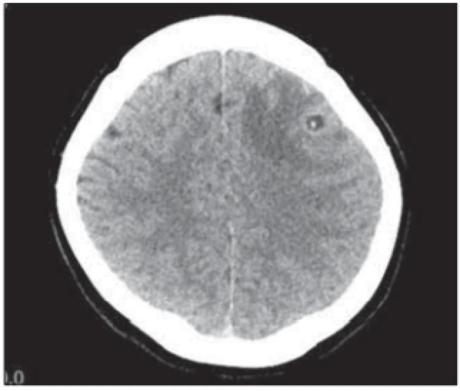 CT scan of the brain, transversal
image. Round-shaped hypodense lesion
in the left frontal region, sized 7 mm, with
central dot-like hyperdensity; the lesion
corresponds to neurocysticercosis. <br>
Obr. 1. CT mozku, transverzální řez. Kulovité hypodenzní ložisko frontálně vlevo
velikosti 7 mm, s centrální tečkovitou hyperdenzitou odpovídá neurocysticerkóze.
