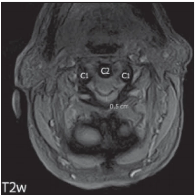 MR. Axiální T2* vážené skeny, tečkovaně vyznačen pannus, je patrná komprese míchy.<br>
Fig. 2. MRI. Axial T2WI scans, dotted outlines pannus, compression of spinal cord
is evident.