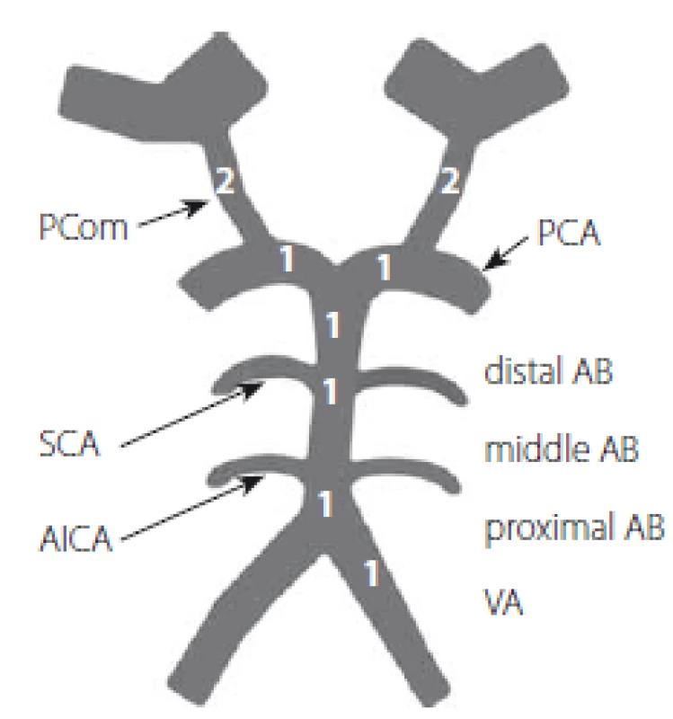 Basilar Artery on Computed Tomography
Angiography (BATMAN) skóre,
které zahrnuje důležitost daného segmentu.
Podle Alemseged et al [1].
AICA – arteria cerebelli inferior anterior; AB –
arteria basilaris (3 b); PCA – arteria cerebri
posterior (2 b); PCom – arteria communicans
posterior (4 b); SCA – arteria cerebelli superior;
VA – arteria vertebralis (1 b)<br>
Fig. 1. Basilar Artery on Computed Tomography
Angiography (BATMAN) score that
includes the importance of the segment.
According to Alemseged et al. [1].
AICA – anterior inferior cerebellar artery;
AB – basilar artery (3 p); PCA – posterior cerebral
artery (2 p); PCom – posterior communicating
artery (4 p); SCA – superior cerebellar
artery; VA – vertebral artery (1 p)