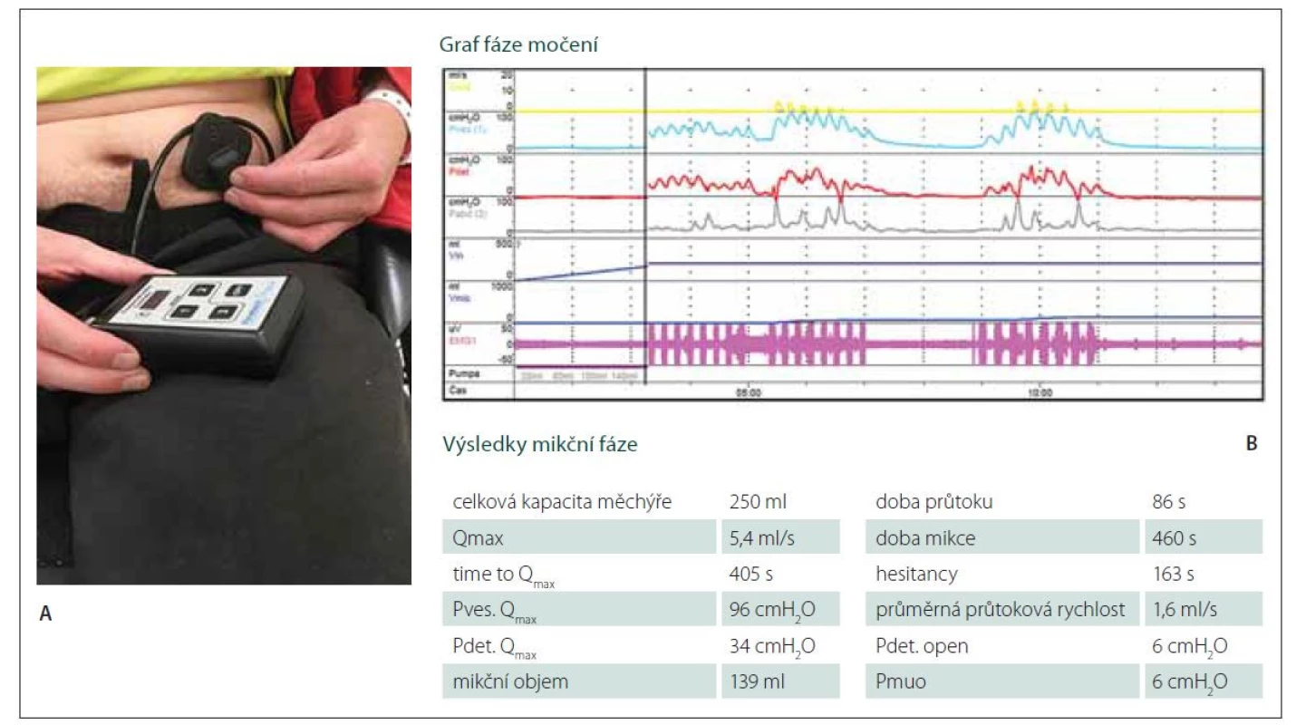 Výsledek urodynamického vyšetření 1 rok od operace.<br>
(A) Autostimulace pacientem 1 rok po implantaci Brindleyho stimulátoru. (B) Výsledek urodynamického vyšetření 1 rok od operace. Horní,
žlutá křivka ukazuje vlastní fázi močení vyvolané aktivací Brindleyho stimulátoru.<br>
Fig. 2. Results of urodynamic assessment 1 year after surgery.<br>
(A) Auto-stimulation 1 year after Brindley stimulator implantation. (B) Results of urodynamic assessment 1 year after surgery.
The upper (yellow) curve shows a phase of voiding induced by activation of the Brindley stimulator.