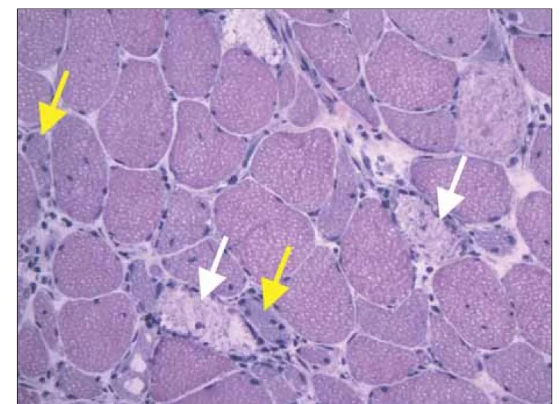 Histologické vyšetření svalové biopsie (m. vastus lateralis vpravo), barvení hematoxilin-
eosin. Jsou přítomna početná nekrotická svalová vlákna (bílé šipky) s regenerujícími
bazofilními myoblasty (žluté šipky). Nečetné lymfocyty a makrofágy jsou přítomny
v rámci úklidové reakce.<br>
Fig. 2. Histology of muscle biopsy (rightside m. vastus lateralis), hematoxilin-eosin staining.
There are numerous necrotic muscle fibers (white arrows) with regenerating basofil myoblasts (yellow arrows). Only a few lymfocytes and macrophages are present as
a part of healing response.