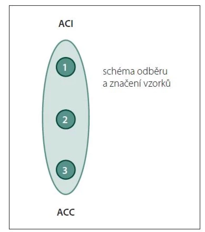 Schéma odběru a označení vzorku
aterosklerotického plátu.<br>
ACC – arteria carotis communis; ACI – arteria
carotis interna<br>
Fig. 1. Atherosclerotic plaque sampling
and labeling scheme.<br>
ACC – common carotid artery; ACI – internal
carotid artery
