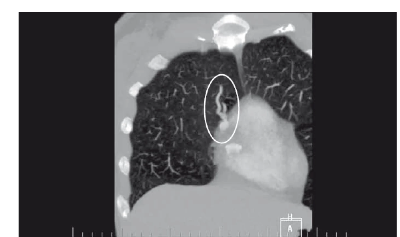 Průkaz plicní arteriovenózní malformace pomocí CTA plic.<br>
Fig. 2. Pulmonary arteriovenous malformation prooved via CT pulmonary angiogram.