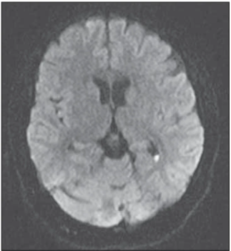 Control diff usion weighted MRI after 10 days. Focal lesions related to edema
were largely resolved.<br>
Obr. 2. Kontrolní difuzí vážená MR po
10 dnech. Ložiskové léze v důsledku
edému z velké části vymizely.