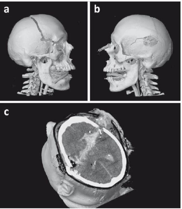 3D rekonstrukce z vyšetření CT znázorňující průstřel hlavy střelou
ráže 9 mm.<br>
(a) Relativně malý pravidelný vstřel temporálně vpravo a dislokovaná fraktura kalvy.<br>
(b) Výstřel temporoparietálně vlevo s tříštivou frakturou kalvy v okolí.<br>
(c) Axiální řez na CT ukazující střelný kanál. Krev a kostní fragmenty jsou na zachyceném řezu
ve střelném kanálu i v okcipitálních rozích postranních komor.<br>
Fig. 3. 3D CT reconstruction displaying a penetrating craniocerebral gunshot wound
caused by a 9-mm round.<br>
(a) Relativelly small, round entry wound in the right temporal region and dislocated skull
fracture.<br>
(b) Exit wound in the left temporoparietal region surrounded by radiating comminuted
fractures.<br>
(c) CT axial slice showing the wound channel. Note the bone fragments and blood in the
wound channel and occipital horns of the lateral ventricles.