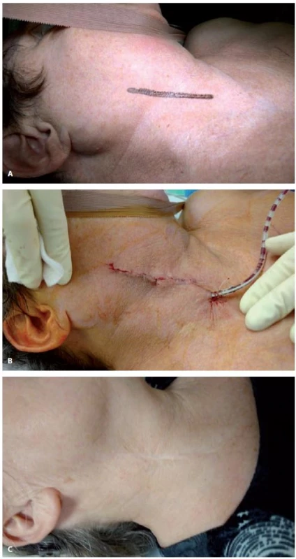 Předoperační (A), perioperační (B) a pooperační (C) obraz při použití krátkého podélného kožního řezu u karotické endarterektomie.<br>
Fig. 2. Preoperative (A), perioperative (B) and postoperative (C) images of the short longitudinal skin incision during carotid endarterectomy.