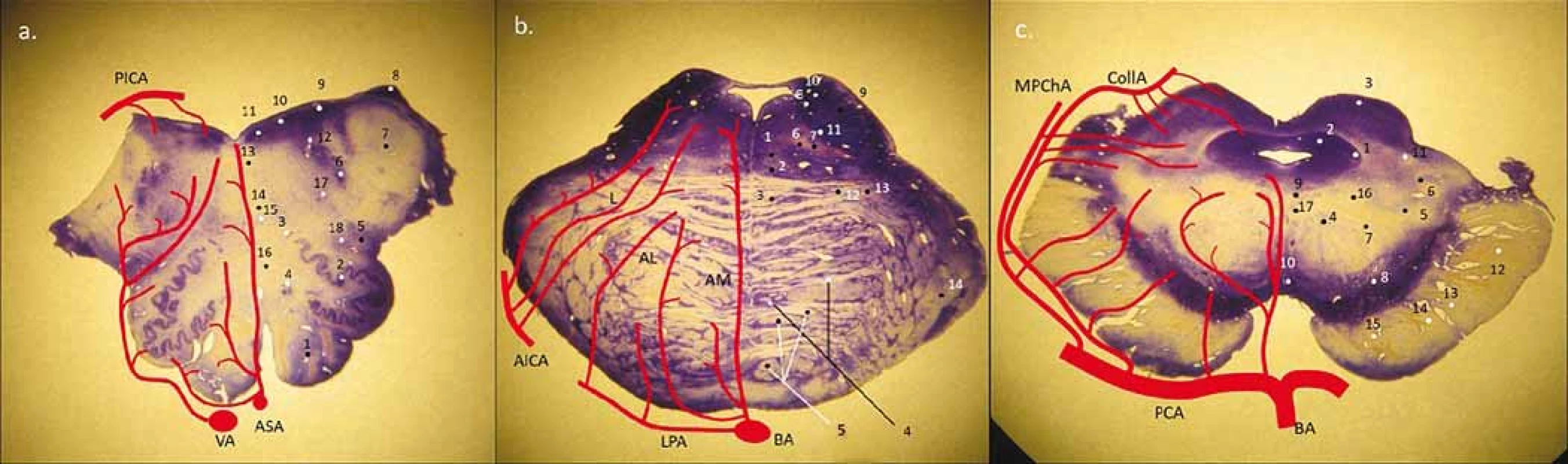 Obecné schéma perforujících arterií na úrovni oblongaty, pontu a mezencefala, tzn. rozdělení na anteromediální,
anterolaterální, laterální skupiny a v oblasti mesencefala a pontu i posteriorní skupinu (z PICA, MPChA, CollA).
(a) medulla oblongata – 1. pyramis medullae oblongatae; 2. ncl. olivaris inferior; 3. ncl. olivaris dosrsalis accessorius; 4. ncl. reticularis lateralis;
5. tr. spino-thalamicus (anterolaterální systém) a spinocerebellaris ant.; 6. ncl. et tr. spinalis nervi trigemini; 7. pedunculus cerebellaris inferior
(corpus restiforme); 8. ncl. cuneatus accessorius; 9. ncl. vestibularis inferior et medialis; 10. ncl. dorsalis n. vagi; 11 ncl. nervi hypoglossi;
12. fasciculus longitudinalis medialis; 13. tr. tecto-spinalis; 14. lemniscus medialis; 15. ncl. ambiguus; 16 tr. et ncl. solitarius
(b) pons – 1. fasciculus longitudinalis medialis; 2. tr. tecto-spinalis a tr. reticulo-spinalis; 3. lemniscus medialis; 4. ncl. pontis; 5. tr. corticospinalis
(roztříštěné svazky pyramid); 6. tr. centralis tegmenti; 7. tr. rubrospinalis; 8. ncl. vestibularis superior; 9. pedunculus cerebellaris superior
(brachium conjunctivum); 10. tr. et ncl. mesencephalicus CN V.; 11. ncl. motorius et pontinus CN V.; 12. tr. spino-thalamicus (anterolaterální
systém); 13. tr. spinocerebellaris anterior; 14. peduncullus cerebellaris medius (brachium pontis)
(c) mezencefalon – 1. ncl. mesencephalicus CN V.; 2. substantia grisea centralis; 3. colliculus superior; 4. ncl. ruber; 5. lemniscus medialis;
6. tr. spino-thalamicus (anterolaterální systém); 7. tr. cerebellothalamicus; 8. susbstnatia nigra (reticularis et compacta); 9. pedunculus (crus
cerebri); 10. ncl. nervi oculomotorii (CN III.); 11. ncl. interpeduncularis; 12. ncl. spinotectalis; 13. tr. occipito-, temporo-, parieto-pontinnus;
14. tr. corticospinalis; 15. tr. corticonuclearis; 16. tr. fronto-pontinnus; 17. tr. centralis tegmenti; 18. fasciculus longitudinalis medialis
AICA – arteria cerebelli inferior anterior; AL – anterolaterální skupina; AM – anteromediální skupina; ASA – arteria spinalis anterior; BA –
arteria basiliaris; CN – hlavový nerv; CollA – arteria collicularis; L – laterální skupina; LPA – laterální pontinní arterie; MPChA – arteria choroidea
posterior medialis; PCA – arteria cerebri posterior; PICA – arteria cerebelli inferior posterior; VA – arteria vertebralis<br>
Fig. 1. General scheme of perforators in the medulla oblongata, pons and mesencephalon with division into the anteromedial,
anterolateral, lateral group and in the area of mesecephalon and pons and also in the posterior group (from PICA, MPChA, CollA).
(a) medulla oblongata – 1. pyramis medullae oblongatae; 2. ncl. olivaris inferior; 3. ncl. olivaris dorsalis accessorius; 4. ncl. reticularis lateralis;
5. tr. spino-thalamicus (anterolateral system) et spinocerebellaris ant.; 6. ncl. et tr. spinalis nervi trigemini; 7. pedunculus cerebellaris inferior
(corpus restiforme); 8. ncl. cuneatus accessorius; 9. ncl. vestibularis inferior et medialis; 10. ncl. dorsalis n. vagi; 11. ncl. nervi hypoglossi;
12. fasciculus longitudinalis medialis; 13. tr. tecto-spinalis; 14. lemniscus medialis; 15. ncl. ambiguus; 16. tr. et ncl. solitarius
(b) pons – 1. fasciculus longitudinalis medialis; 2. tr. tecto-spinalis et tr. reticulo-spinalis; 3. lemniscus medialis; 4. ncl. pontis; 5. tr. corticospinalis
(crashed pyramidal columns); 6. tr. centralis tegmenti; 7. tr. rubrospinalis; 8. ncl. vestibularis superior; 9. pedunculus cerebellaris superior
(brachium conjunctivum); 10. tr. et ncl. mesencephalicus CN V.; 11. ncl. motorius et pontinus CN V.; 12. tr. spino-thalamicus (anterolateral
system); 13. tr. spinocerebellaris anterior; 14. peduncullus cerebellaris medius (brachium pontis)
(c) mesencephalon – 1. ncl. mesencephalicus CN V.; 2. substantia grisea centralis; 3. colliculus superior; 4. ncl. ruber; 5. lemniscus medialis;
6. tr. spino-thalamicus (anterolateral system); 7. tr. cerebellothalamicus; 8. substantia nigra (reticularis et compacta); 9. pedunculus (crus
cerebri); 10. ncl. nervi oculomotorii (CN III.); 11. ncl. interpeduncularis; 12. ncl. spinotectalis; 13. tr. occipito-, temporo-, parieto-pontinnus;
14. tr. corticospinalis; 15. tr. corticonuclearis; 16. tr. fronto-pontinnus; 17. tr. centralis tegmenti; 18. fasciculus longitudinalis medialis
AICA – anterior inferior cerebellar artery; AL – anterolateral group; AM – anteromedial group; ASA – arteria spinalis anterior; BA – basilar artery;
CN – cranial nerve; CollA – collicular artery; L – laterar group; LPA – lateral pontine artery; MPChA – medial posterior choroidal artery;
PCA – posterior cerebral artery; PICA – posterior inferior cerebellar artery; VA – vertebral artery