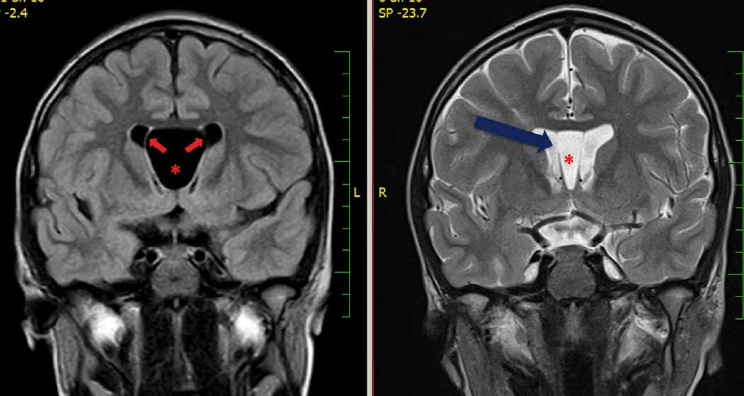 Na obrázku vlevo je zobrazena expanzivně se chovající cysta cavum septi pellucidi (*) s balonovým vyklenování stěn cysty
(šipky). Na obrázku vpravo je patrné výrazné zmenšení cysty po její úspěšné endoskopické marsupializaci. Modrá šipka znázorňuje defekt
v septum pellucidum vpravo.<br>
Fig. 6. The fi gure on the left side shows an expansive cyst of the cavum septi pellucidi (*) with a balloon-shaped bulging of the cyst
walls (arrows). On the right side is signifi cant shrinkage of the cyst after its successful endoscopic marsupialization. The blue arrow
shows the defect in the septum pellucidum on the right side.