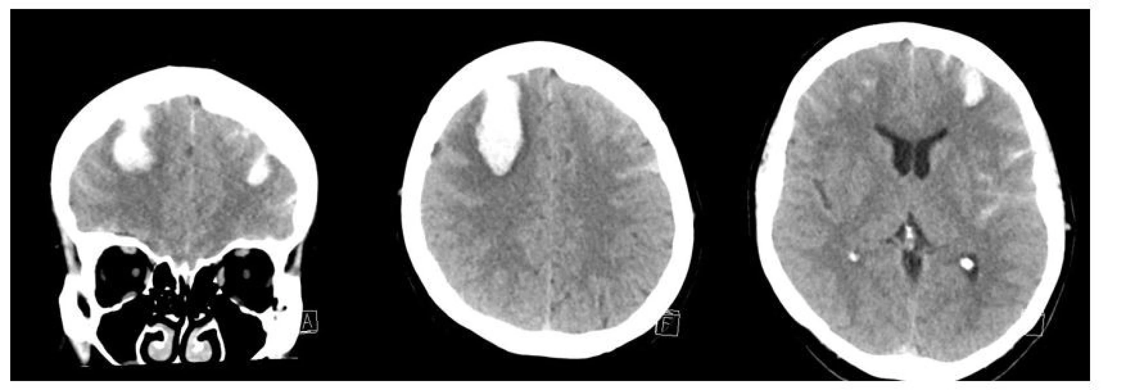 Vstupní vyšetření CT mozku. <br>
Fig. 2. Initial CT scan of the brain.
