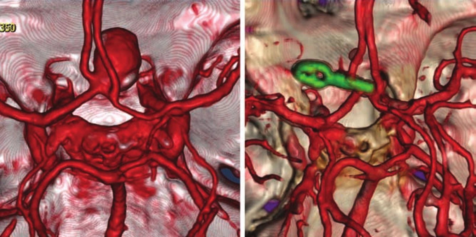 CTA aneuryzmatu arteria communicans anterior před a po clippingu.<br>
Fig. 4. CTA of the anterior communicating artery aneurysm before and after clipping.