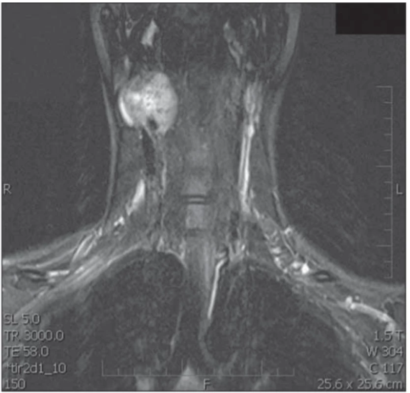  T1-weighted MRI scan, after administration of gadolinium, demonstrates a mass within the right carotid space. Both
the external carotid artery and the internal carotid artery are
constricted.<br>
Obr. 1. T1-vážený obraz MR po podání gadolinia. Viditelná masa
karotické prostoru vpravo zaujímající a. carotis externa a interna.