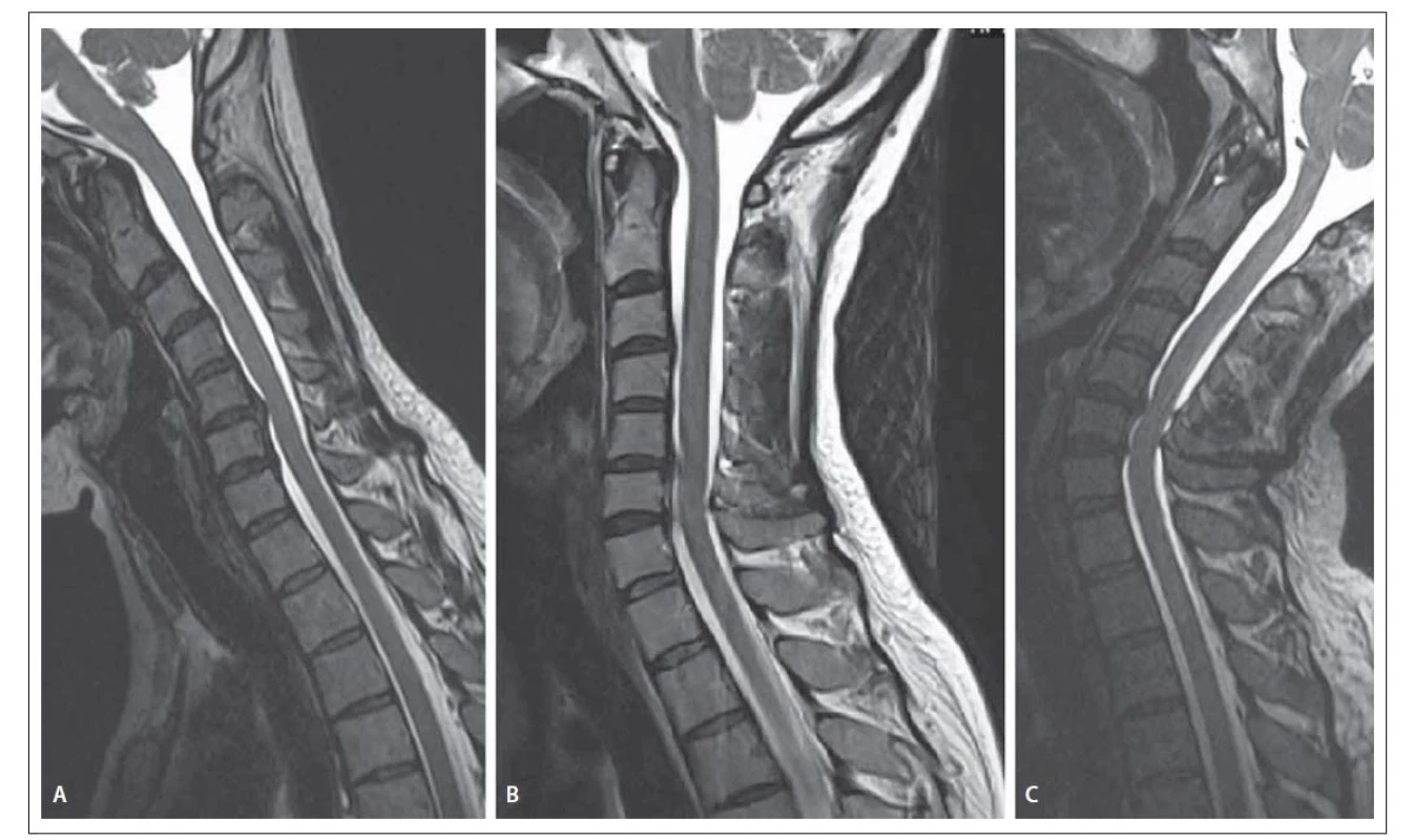 Dynamická MR krční páteře u pacienta č. 9. (A) Flexe C páteře: Muhle stupeň 2; (B) neutrální poloha: Muhle stupeň 1; (C) extenze
C páteře: Muhle stupeň 3.<br>
Fig. 3. Dynamic MRI of the cervical spine in patient No. 9. (A) Flexion of cervical spine: Muhle grade 2; (B) neutral position: Muhle
grade 1; (C) extension of cervical spine: Muhle grade 3.