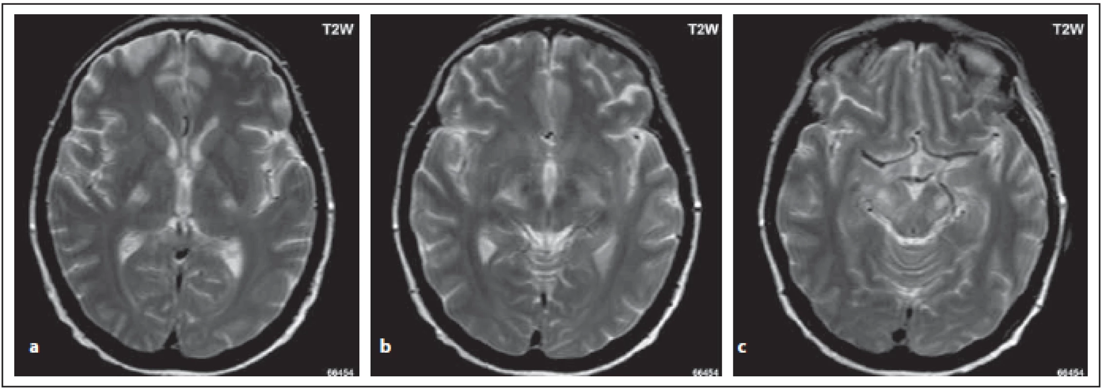 Pacient s MOG-IgGpozNMOSD, stejný pacient jako na obr. 3. Je patrný zvýšený signál v T2 váženém obraze v oblasti pyramidové
dráhy bilat. – v zadních ramínkách kapsuly interny (a, b), v cerebrálních pedunkulech mozkového kmene (c).<br>
Fig. 7. MOG-IgGposNMOSD patient, the same patient as in Fig. 3. High signal is evident in T2-weighted image bilaterally in the pyramidal
tract – in the dorsal limb (a, b), in cerebral peduncles (c).