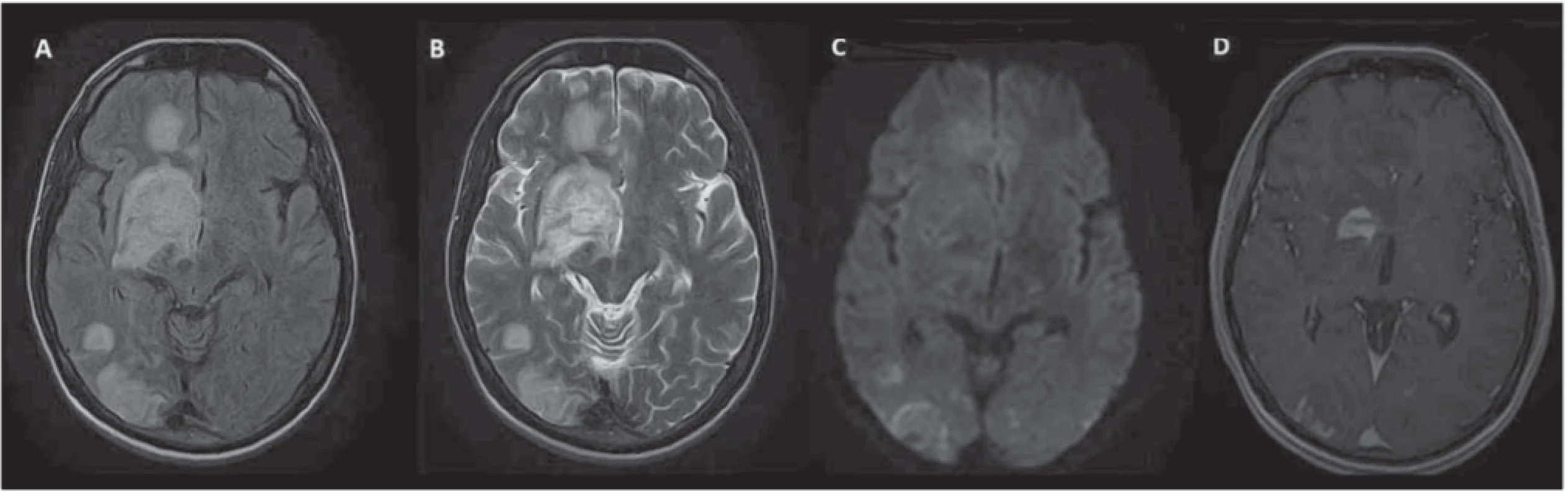 MR mozku – rozsáhlé ložiskové postižení intrakraniálních struktur s maximem v oblasti bazálních ganglií vpravo, některé léze
jsou expanzivní, s vazogenním edémem.<br>
Fig. 1. Brain MRI – extensive focal involvement of intracranial structures, especially in right-sided basal ganglia; some lesions are expansive with vasogenic edema. 