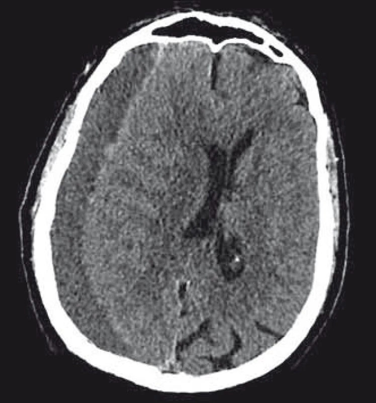 CT mozku s typickým nálezem
chronického subdurálního hematomu
fronto-temporo-parieto-okcipitálně
vpravo.<br>
Fig. 1. CT scan of the brain with a typical
fi nding of a chronic subdural haematoma
in the right fronto-temporo-parieto-occipital
area.