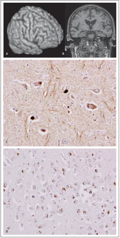 MR a neuropatologie 
u frontotemporální demence 
s amyotrofi ckou laterální sklerózou.<br>
Fig. 3. MRI and neuropathology in frontotemporal dementia and a myotrophic lateral sclerosis.