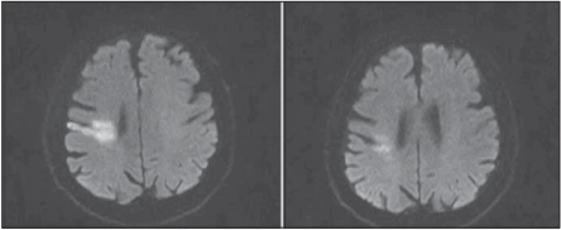 Difúziou vážená MR mozgu, b1000 – (a) po zhoršení klinického stavu; 
(b) predoperačne.<br>
Fig. 2. Brain MR diff usion weighted image, b1000 – (a) after clinical deterioration; 
(b) before surgery.