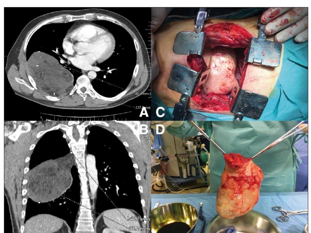 (A) Objemný mediastinální tumor zobrazený na CT – transverzální projekce; (B) CT hrudníku – koronární projekce; (C) peroperační
snímek – torakotomie s tumorem vyplňujícím pohrudniční dutinu; (D) resekovaný neurofi brom<br>
Fig. 2. (A) CT scan showing voluminous mediastinal tumor – transverse plane; (B) thoracic CT scan – coronal plane; (C) intraoperative
view – thoracotomy showing a large mediastinal tumor; (D) resected neurofi broma