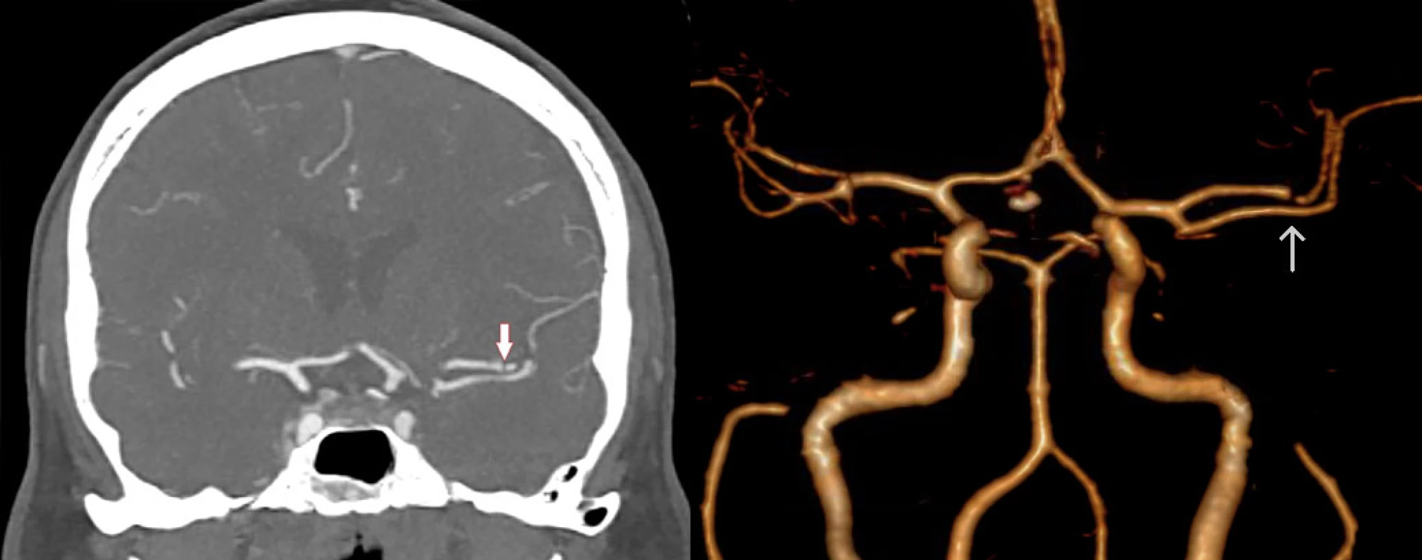 CTA in coronal section (left) and 3D reconstruction (right) shows short intraluminal filling defect in the M2 segment of the left MCA (arrow). MCA – middle cerebral artery<br>
Obr. 1 CTA ve frontálním řezu (vlevo) a 3D rekonstrukce (vpravo) ukazuje krátký intraluminální defekt v úseku M2 levé ACM (šipka). ACM – arteria cerbri media