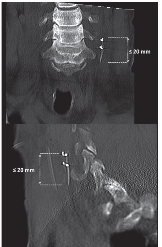 Pooperační CT s ponechaným zbytkem elektrody na vagovém nervu.<br>
Fig. 5. Postoperative CT with the remainder of the electrode on the vagal nerve.