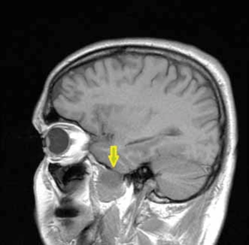Zobrazenie trigeminálneho
schwannómu na MR-T2 váženi, označené
šípkou.<br>
Fig. 4. MRI-T2 image of the trigeminal
schwannoma marked by an arrow.