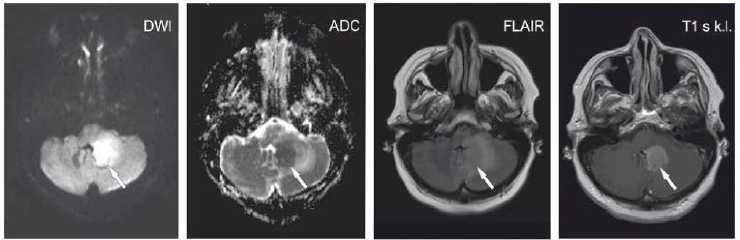 Pacientka ve věku 62 let s expresivní afázií, centrální lézí n. VII. vpravo a pravostrannou hemiparézou. V levé mozečkové hemisféře je patrné ložisko (šipky) při IV. komoře, která je mírně dislokována doprava. Je patrný DWI hypersignální okrsek s ADC hyposignálním korelátem.
Na FLAIR je ložisko lehce hypersignální s kolaterálním edémem. Po aplikaci kontrastní látky se léze homogenně nasytila. Další obdobné ložisko temporo-parieto-okcipitálně vlevo. Lymfom.<br>
ADC – aparentní difuzní koefi cient; DWI – difuzí vážený obraz; FLAIR – inverzní zobrazení s potlačením signálu tekutiny; k. l. – kontrastní látka<br>
Fig. 3. A 62-year-old woman with expressive aphasia, a central lesion of the seventh cranial nerve on the right side, and right-sided hemiparesis.
The lesion is apparent in the left cerebellar hemisphere (arrows) alongside the fourth ventricle that is dislocated slightly to the right.
DWI hypersignal area with an ADC hyposignal corresponding area is seen. The lesion is slightly hyper-signal on FLAIR with collateral
edema. Homogeneous enhancement was seen after contrast administration. Another similar lesion is temporo-parieto-occipitally on the left.
Lymphoma.<br>
ADC – apparent diffusion coefficient; DWI – diffusion-weighted image; FLAIR – fluid attenuated inversion recovery; k. l. – contrast agent