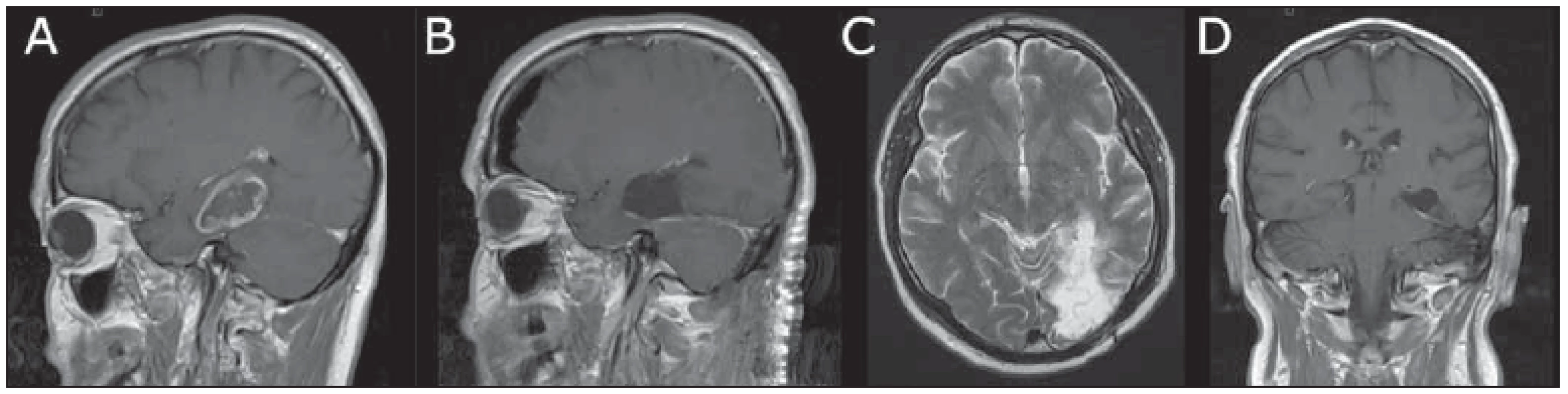 Transtentoriálně resekovaný glioblastoma multiforme hipokampu u 60letého pacienta. <br>
Fig. 1 Transtentorially-resected glioblastoma multiforme of the hippocampus in a 60-year-old male.