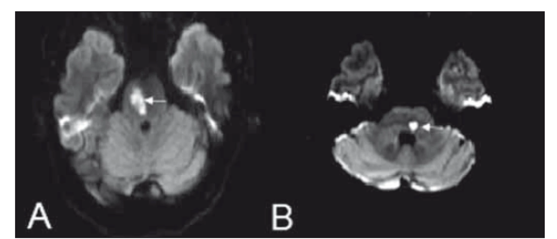 (A) Millard-Gublerův syndrom a (B) laterální střední pontinní
syndrom na difuzí vážených obrazech MR.<br>
Fig. 7. Diff usion weighted MRI showing images of Millard-Gubler
syndrome (A) and lateral middle pontine syndrome (B).