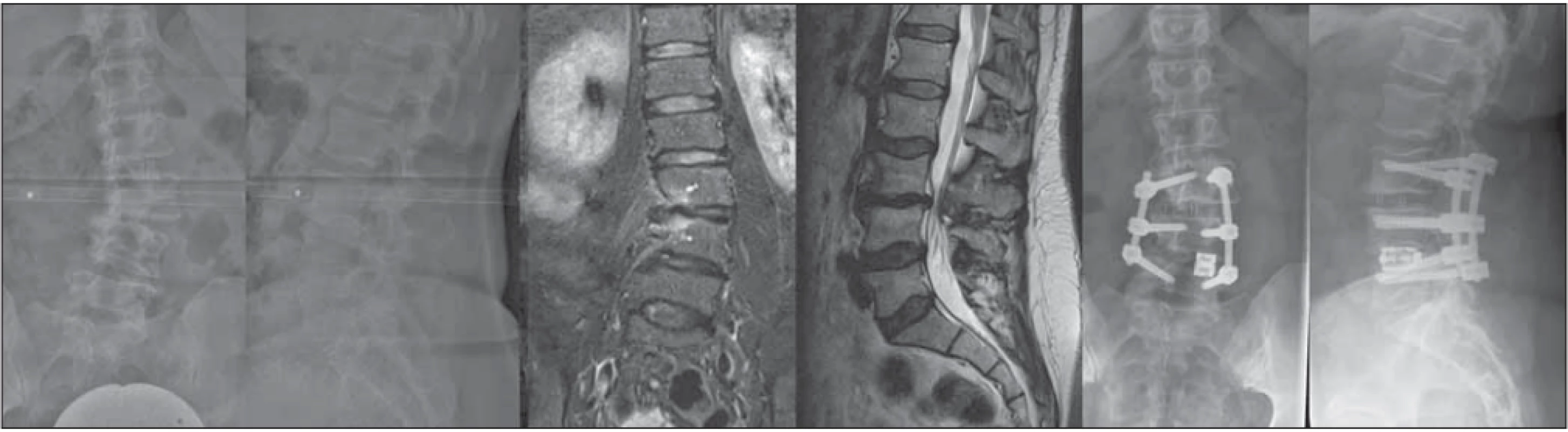 55-ročná pacientka s radikulárnymi bolesťami L3 a neurogénnymi klaudikáciami, grafi cký nález jednostrannej subartikulárnej stenózy a foraminálnej stenózy L3/4 vpravo, po distrakcii v segmente L4/5 vľavo expandibilnou PLIF klietkou, dekompresiou a XLIF
L3/4 významná korekcia deformity, subj. zmiernenie bolestivého syndrómu.<br>
Fig. 1. 55-year old female patient with radicular pain in dermatomes L3 with neurogenic claudication, and with imaging fi ndings of unilateral subarticular stenosis and right foraminal stenosis in segment L3/4. After distraction of segment L4/5 on the left with an expandible PLIF
cage, decompression and XLIF of L3/4 was performed with signifi cant correction of deformity and subjective relief of the pain syndrome.