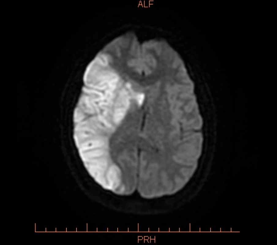  MR vyšetrenie mozgu – difúzne viazané važené zobrazenie, 5. deň po vykonaní MT.