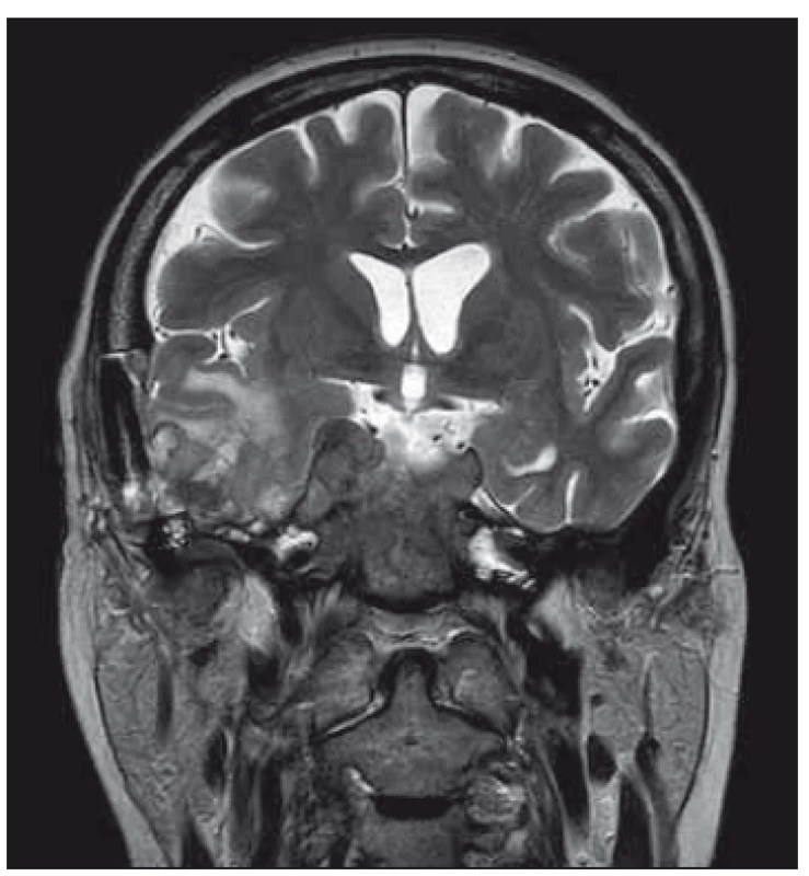 Výrazná progrese rozsahu infiltrátu
v oblasti kavernózního sinu a s vícečetnými
hematomy vpravo temporálně.<br>
Fig. 1. Significant progress in the infiltrating
range in the region of cavernous
sinus and with the multiple hematomas in
right temporal lobe.