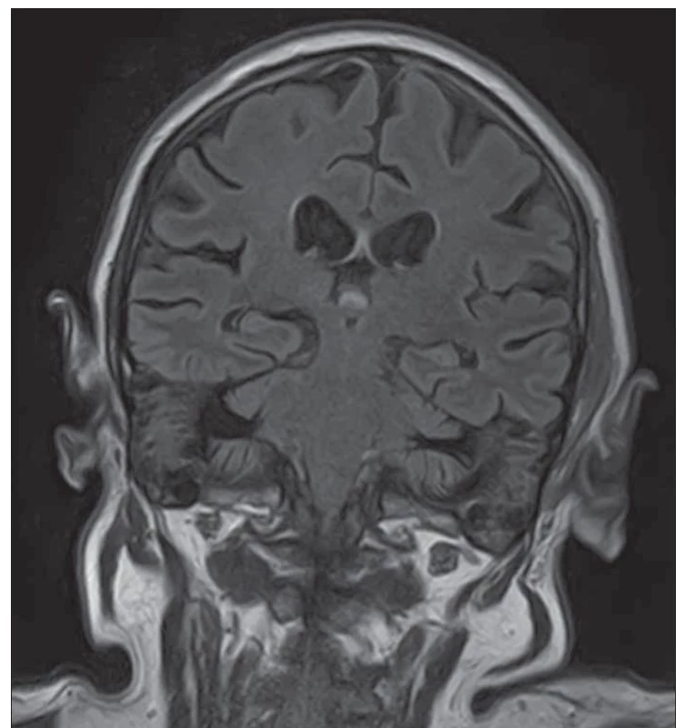 MR mozku, FLAIR, koronární snímek – normální nález.<br>
FLAIR – fluid attenuated inversion recovery<br>
Fig. 1. Brain MRI, FLAIR, coronary view – normal findings.<br>
FLAIR – fluid attenuated inversion recovery
