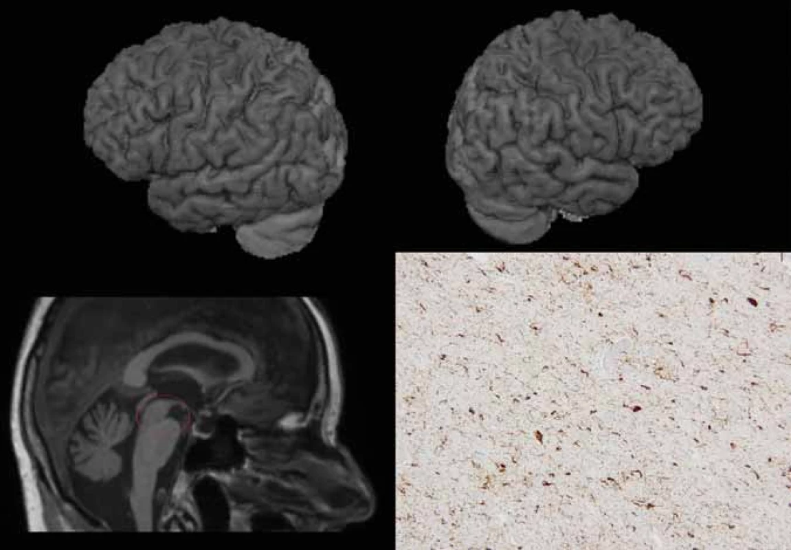 Primární apraxie řeči – MR a neuropatologie.
3D povrchová rekonstrukce mozku na základě 3D T1-vážených obrazů MR – nahoře vlevo (a) pohled na levou hemisféru, nahoře vpravo (b)
na pravou; vlevo dole (c) sagitální řez se zaměřením na mozkový kmen.
Nález na MR s jen minimální korovou atrofií, na sagitálním řezu je však patrna atrofie v dorzální části mezencefala (příznak „tučňáka“).
d) Neuropatologický obraz – diagnostická depozita hyperfosforylovaného tau proteinu v imunohistochemickém průkazu protilátkou klonu
AT8 v neokortexu odpovídající vyvinuté progresivní supranukleární obrně. <br>
Fig. 4. Primary apraxia of speech – MRI and neuropathology.
3D surface reconstruction (volume rendering technique) of the brain based on 3D T1-weighted MRI images – left hemisphere above on the
left (a), right hemisphere above on the left (b). Below on the left (c) sagittal slice showing the brainstem.
MRI fi ndings with only mild cortical atrophy; however, the sagittal image shows atrophy of the dorsal midbrain (“penguin sign”).
d) Neuropathology – deposits of hyperphosphorylated tau protein in immunohistochemical staining with antibody against AT8 clones in
the neocortex corresponding to developed progressive supranuclear palsy