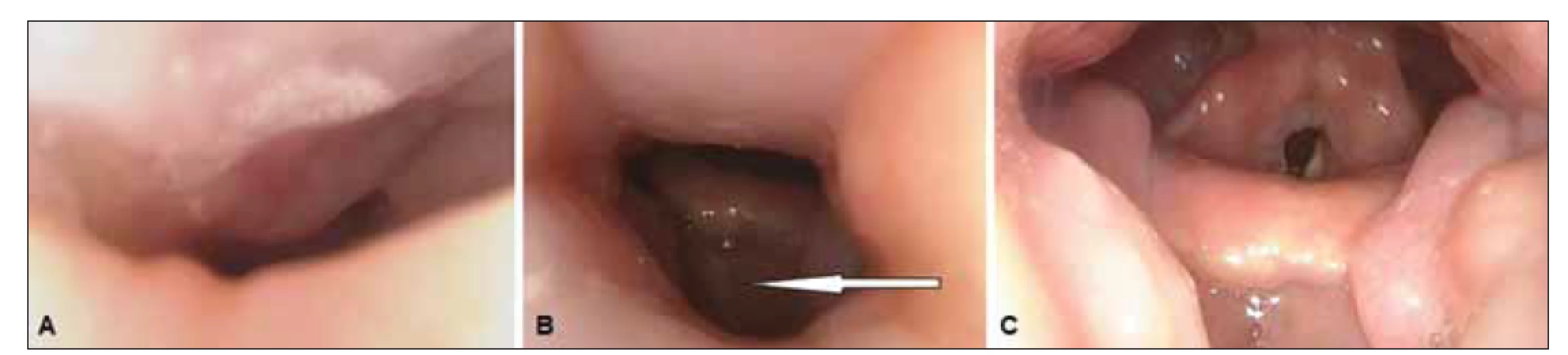 Spánková endoskopie s přetlakovou ventilací, endoskopický pohled na horní dýchací cesty. (A) Předozadní obstrukce měkkého
patra při tlaku 0 hPa; (B) stav horních dýchacích cest při tlaku 12 hPa – částečná obstrukce v oblasti měkkého patra a orofaryngu, přetrvávání
úplné obstrukce kořene jazyka s útlakem epiglottis (šipka); (C) horní dýchací cesty volné ve všech etážích při tlaku 18 hPa.<br>
Fig. 3. Drug-induced sleep endoscopy with positive airway pressure; endoscopic view of the upper airways. (A) Anteroposterior
obstruction of the soft palate at a pressure of 0 hPa; (B) posture of the upper airways at a pressure of 12 hPa – partial obstruction in the area
of the soft palate and oropharynx, and persistence of complete obstruction of the root of the tongue with the oppression of the epiglottis
(arrow); (C) upper airways without obstruction in all sites at a pressure of 18 hPa.