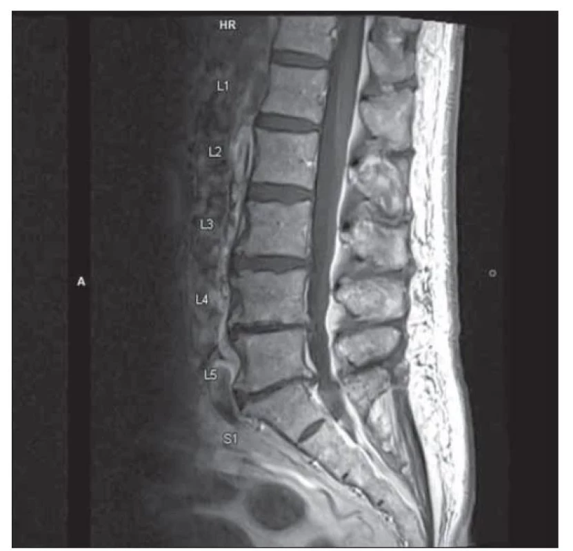 MR lumbosakrální páteře, T1 vážený obraz, sagitální řez:
stenóza bederní páteře L4–S1.<br>
Fig. 1. MRI of lumbosacral spine, T1 weighted image, sagittal
plane: lumbar spinal stenosis L4–S1.