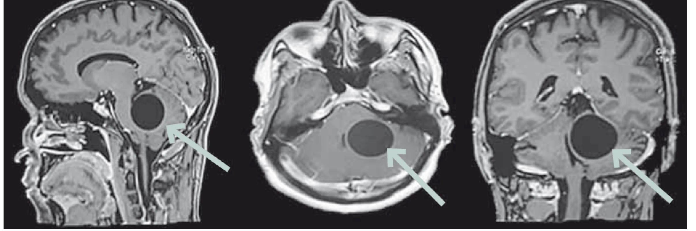 Sagittal, axial and coronal sections of a brain MRI on T1-WI after the administration
of Gadolinium showing a left vermio-lobar cystic, homogenous, well-shaped lesion
compressing the brain stem and the fourth ventricle.<br>
Obr. 1. Sagitální, axiální a koronární řezy na MR mozku v T1 váženém obraze po aplikaci
gadolina ukazují levostrannou vermio-lobární cystickou, homogenní, dobře ohraničenou
lézi utlačující mozkový kmen a čtvrtou mozkovou komoru.