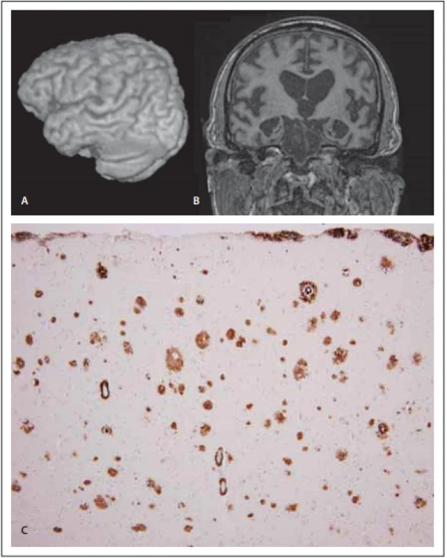 MR a neuropatologie u frontální 
varianty Alzheimerovy nemoci.<br>
Fig. 4. MRI and neuropathology in the 
frontal variant of Alzheimer‘s disease.