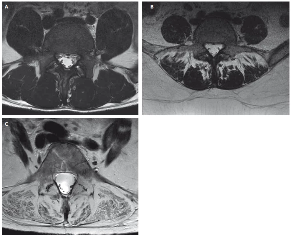 Příklady pacientů s chronickými bolestmi dolní části zad s rozdílnou
tukovou degenerací paraspinálních svalů. Axiální T2 vážený
obraz MR na úrovni L5.
(A) Pacient (22 let) s normálním nálezem v paraspinálních svalech (stupeň
0 dle Gouttalierovy klasifikace).
(B) Pacientka (38 let) se střední tukovou degenerací paraspinálních svalů
(stupeň 2 dle Gouttalierovy klasifikace).
(C) Pacientka (63 let) s těžkou tukovou degenerací paraspinálncíh svalů
(stupeň 4 dle Gouttalierovy klasifikace).
Fig. 3. Examples of patients with chronic low back pain with different
fatty degeneration of paraspinal muscles. Axial T2-weighted MRI
images at the level of L5.<br>
(A) Patient (man, 22 years) with normal morphological constitution of paraspinal
muscles (grade 0 according to the Goutallier Classification).
(B) Patient (woman, 38 years) with moderate fat infiltration and muscle atrophy
of paraspinal muscles (grade 2 according to the Goutallier Classification).
(C) Patient (woman, 63 years) with severe fat infiltration and muscle atrophy
of spinal muscles (grade 4 according to the Goutallier Classification).