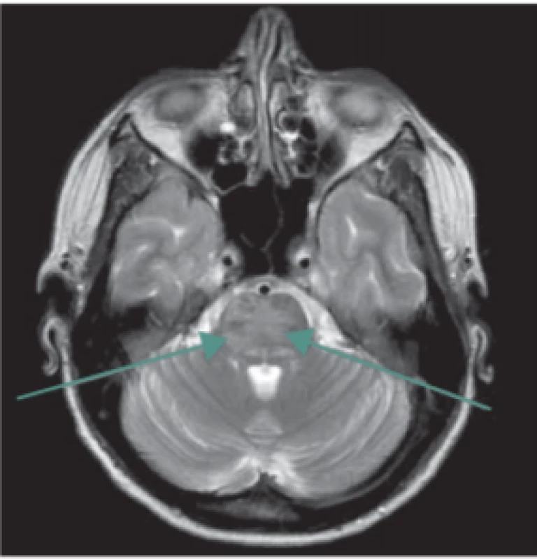  Syndrom reverzibilní encefalopatie
v zadní cirkulaci (PRES syndrom). Vyšetření MR, transverzální T2 turbospin echo
snímek – šipky označují místo patologického (T2 zvýšeného) signálu v oblasti
mozkového kmene.<br>
Fig. 2. Posterior reversible encephalopathy syndrome. MRI scan, transversal T2-
-weighted turbospin echo image – arrows
show pathological T2 hyperintensity in
the brainstem. 