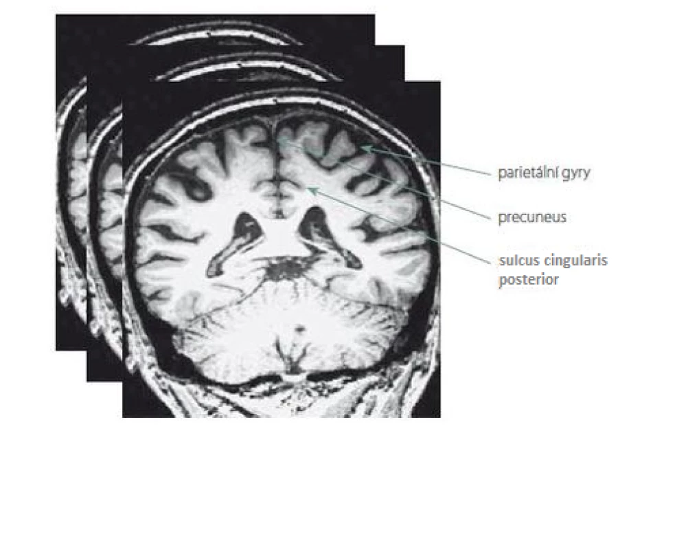 Ilustrace hodnocených oblastí parietálních laloků, které jsou skórovány na sekvenci T1 vážených koronárních řezů MR v rozsahu celých laloků.<br>
Fig. 1. Illustration of the evaluated areas of the parietal lobes, which are scored on multiple T1-weighted coronary MRI images ranging across the entire lobes. 