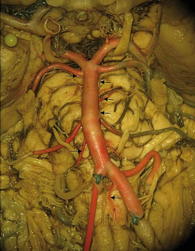 Celkový pohled na vertebrobazillární povodí a jeho odstupující magistrální větve.
Barevný preparát daný injekcí červeného latexu do pravé vertebrální arterie. Šipkami
jsou v kaudokraniálním pořadí označeny spinální arterie anterior vlevo, pontomedullární
arterie vpravo, inferolaterální pontinní arterie vlevo, superolaterální pontinní arterie vlevo
a posterolaterální pontinní arterie oboustranně.<br>
Fig. 2. General picture of vertebrobasilar circulation with its marginal branches.
Specimen colored with red latex administered into the right vertebral artery. Arrows
showing caudocranially left anterior spinal artery, right pontomedullary artery, left
inferolateral pontine artery, left superolateral pontine artery and posterolateral pontine
arteries bilaterally.