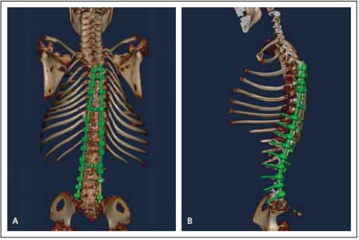 Pooperační vyšetření 3D CT celé páteře (A, B).<br>
Fig. 4. Pooperační vyšetření 3D CT celé páteře (A, B).