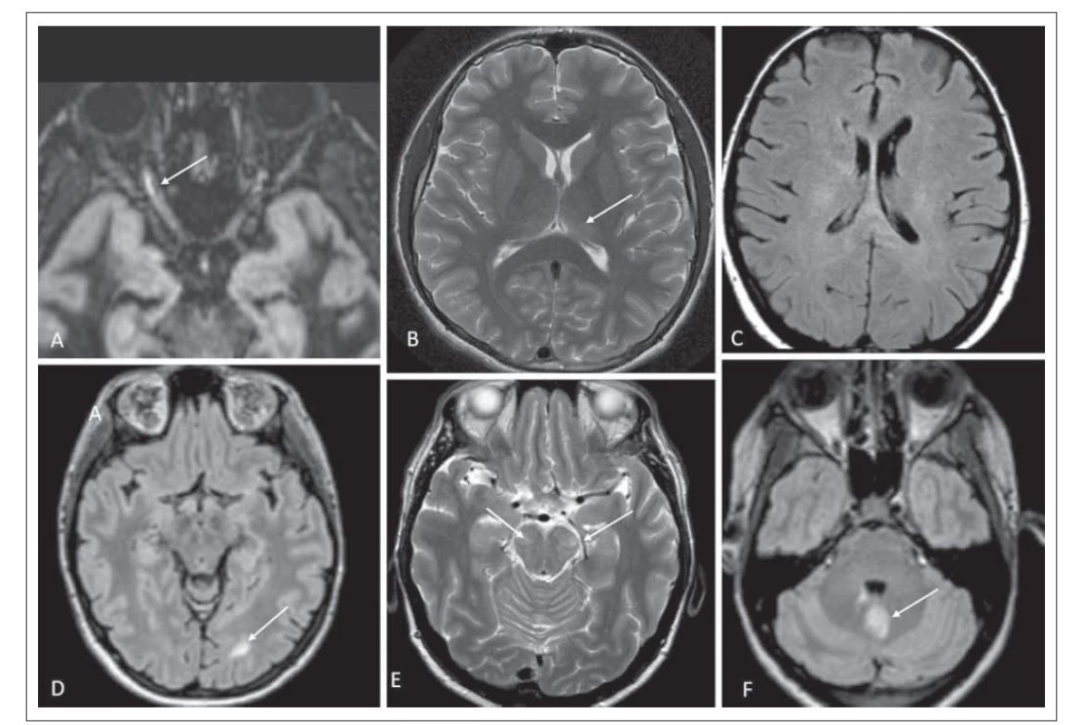 Nálezy na MR v mozkové tkáni a v oblasti nervus opticus. (A) Hypersignální ložisko v oblasti předního segmentu nervus opticus vpravo
odpovídající optické neuritidě v 3D double inversion recovery; pacient číslo 6 (šipka). (B) Neostře ohraničené mírně hypersignální ložisko
v levém thalamu v T2 váženém obraze; pacient číslo 4 (šipka). (C) Nepravidelné zvýšení signálu v bílé hmotě – charakter „fluffy“
ložiska ve FLAIR; pacient číslo 7. (D) Hypersignální ložisko okcipitálně vlevo zasahující subkortikálně v 3D FLAIR; pacient číslo 2 (šipka).
(E) Rozsáhlá ložiska zvýšeného signálu v T2 váženém obraze v mozkových pedunkulech; pacient číslo 7 (šipky). (F) Dvě ložiska v mozečku
v 3D FLAIR (drobné při IV. komoře a druhé rozsáhlejší, šipka); pacient číslo 6.<br>
FLAIR – fluid attenuated inversion recovery<br>
Fig. 3. MRI findings in the brain tissue and in the area of the nervus opticus. (A) Hypersignal lesion in the anterior segment of the right
optic nerve corresponding to optic neuritis on 3D double inversion recovery; patient No. 6 (arrow). (B) A mildly hypersignal lesion
in the left thalamus on a T2-weighted image; patient No. 4 (arrow). (C) Irregular signal increase in the white matter – character of
a “fluffy” lesion in FLAIR; patient No. 7. (D) Hypersignal lesion occipitally in the left extending subcortically on 3D FLAIR; patient No. 2
(arrow). (E) Large lesions of increased signal on T2-weighted image in the cerebral peduncles; patient No. 7 (arrows). (F) Two lesions in
the cerebellum on 3D FLAIR (small one beside the fourth ventricle and a second larger one, arrow); patient No. 6.<br>
FLAIR – fluid attenuated inversion recovery