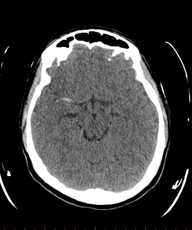 Natívny snímok CT mozgu pred vykonaním MT.