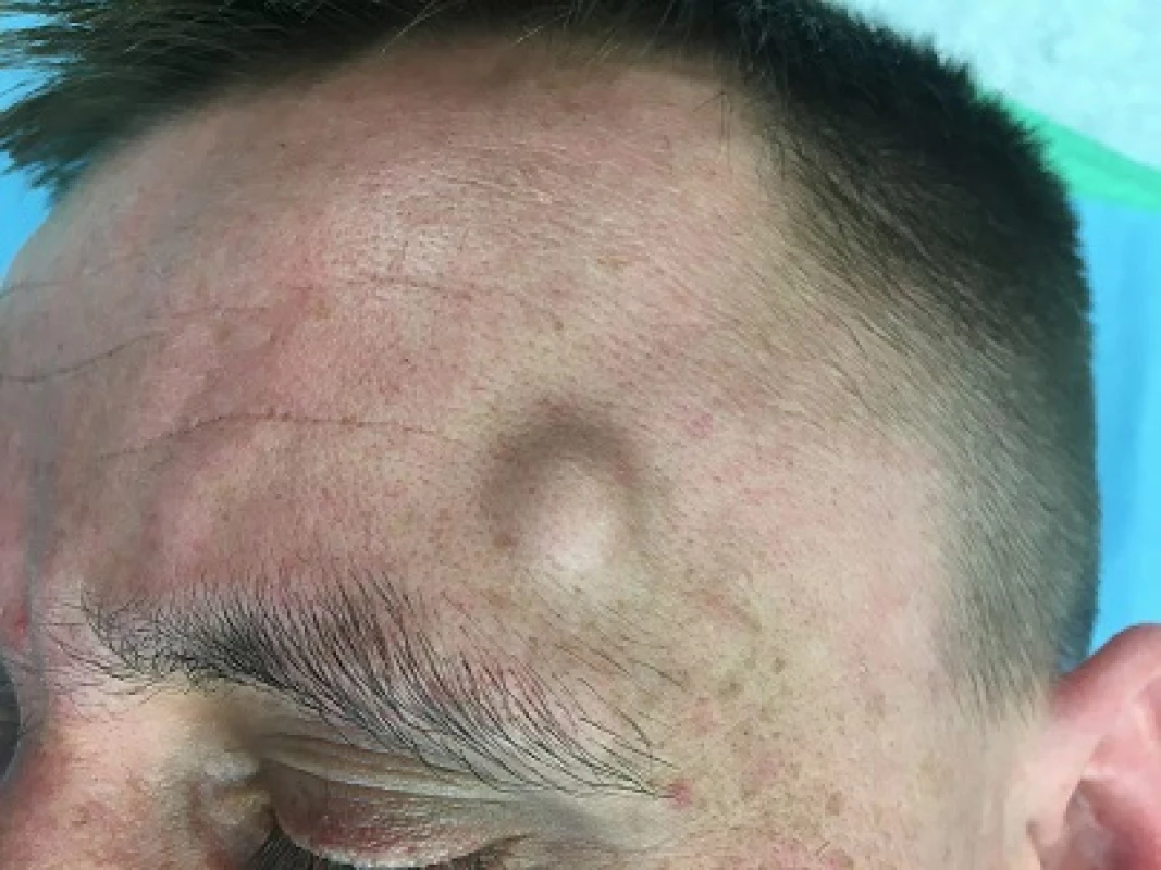 Předoperační fotografie, v čelní krajině vlevo patrná podkožní rezistence.<br>
Fig. 1. Preoperative image, the subcutaneous lump is located on the scalp.