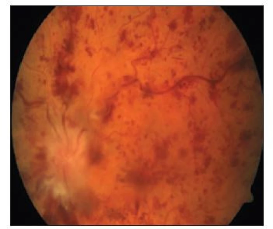 Progrese edému papily a nárůst
počtu hemoragií při sekundární okluzi
centrální retinální vény.<br>
Fig. 1. Progression of papilloedema with
increased number of haemorrhages
due to secondary central retinal vein
occlusion.