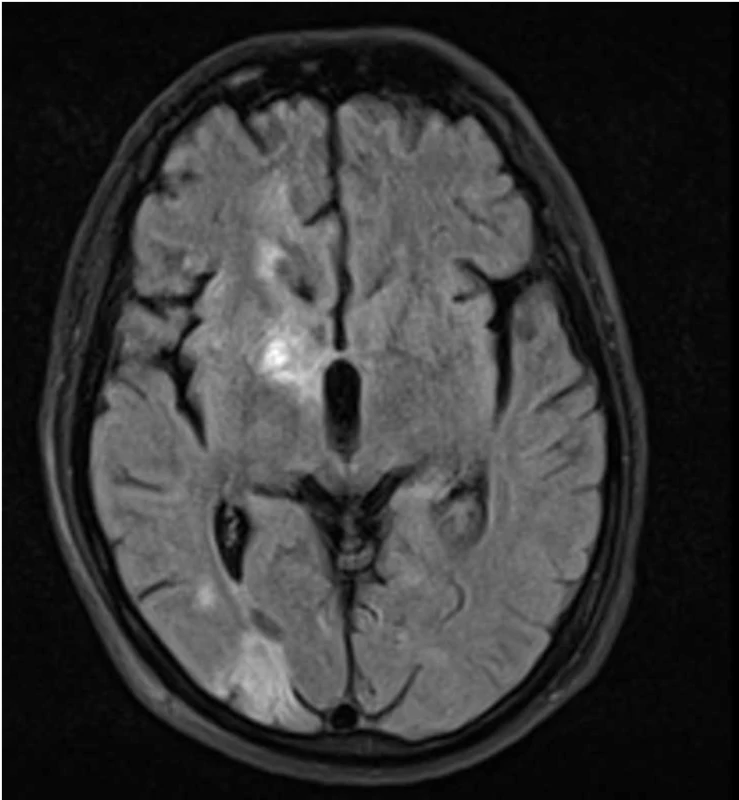 MR mozku (sekvence FLAIR): kontrolní zobrazení po léčbě – výrazná regrese původních lézí.<br>
Fig. 3. Brain MRI (FLAIR): control imaging after treatment – significant regression of previous lesions.