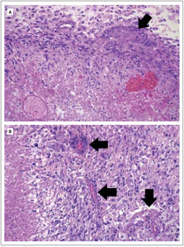  (A) Glioblastom tvořený vysoce atypickými astrocyty gemistocytárního vzhledu
(nahoře), v nádoru přítomno ložisko endoteliální proliferace (šipka) a nekrózy (dole).
(B) Glioblastom tvořený vysoce atypickými astrocyty, v nádoru vícečetná ložiska endoteliální proliferace (šipky) a nekróza (vlevo). Hematoxylin-eosin. Zvětšení 200×.<br>
Fig. 2. (A) Glioblastoma composed of highly atypical astrocytes with gemistocytic features (top). Focus of endothelial proliferation is present (arrow) as well as area of necrosis
(bottom). (B) Glioblastoma is composed of highly atypical astrocytes showing multiple
foci of endothelial proliferation (arrows) and area of necrosis (left). Haematoxylin-eosin.
Magnifi cation 200×.