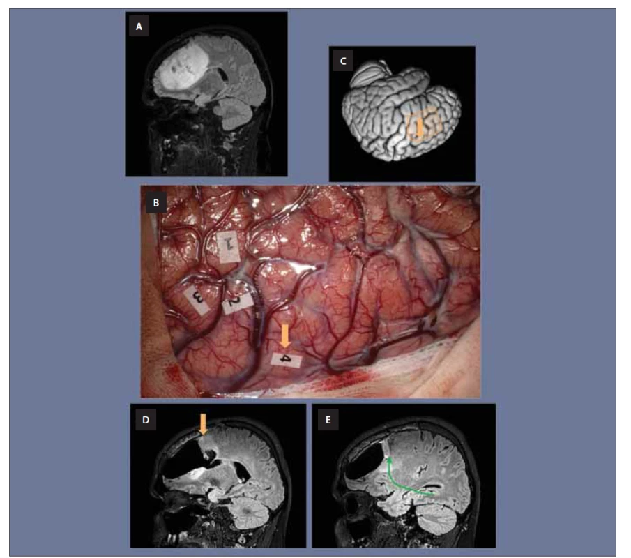 Obr. 5. (A) Snímek MR pacientky s rozsáhlým low grade gliomem v levém frontálním laloku.<br>
(B) Snímek z operace této pacientky prováděné v awake kraniotomii. V místech označených čísly 1, 2 a 3 byla vystimulována motorika
obličeje a nacházejí se na precentrálním gyru. V místě s číslem 4 byly elektrickou stimulací vyvolány sémantické parafázie.<br>
(C) Lokalizace operačního pole je schematicky znázorněna na třírozměrném modelu mozku, oranžová šipka odpovídá místu stimulace
(tedy místu pod číslem 4) a nachází se v dorzální části středního temporálního gyru (odpovídá dorzolaterálnímu prefrontálnímu kortexu,
kde vyúsťuje IFOF).<br>
(D) Při operaci zde muselo být ponecháno reziduum tumoru, jež je patrné na pooperační MR.<br>
(E) Zelenou šipkou pak vidíme znázorněný přibližný průběh IFOFu směřující k tomuto místu.<br>
IFOF – fasciculus fronto-occipitalis inferior<br>
Obr. 5. (A) Snímek MR pacientky s rozsáhlým low grade gliomem v levém frontálním laloku.<br>
(B) Snímek z operace této pacientky prováděné v awake kraniotomii. V místech označených čísly 1, 2 a 3 byla vystimulována motorika<br>
obličeje a nacházejí se na precentrálním gyru. V místě s číslem 4 byly elektrickou stimulací vyvolány sémantické parafázie.<br>
(C) Lokalizace operačního pole je schematicky znázorněna na třírozměrném modelu mozku, oranžová šipka odpovídá místu stimulace
(tedy místu pod číslem 4) a nachází se v dorzální části středního temporálního gyru (odpovídá dorzolaterálnímu prefrontálnímu kortexu,
kde vyúsťuje IFOF).<br>
(D) Při operaci zde muselo být ponecháno reziduum tumoru, jež je patrné na pooperační MR.<br>
(E) Zelenou šipkou pak vidíme znázorněný přibližný průběh IFOFu směřující k tomuto místu.<br>
IFOF – fasciculus fronto-occipitalis inferior